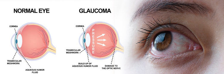 glaucoma eye vs normal eye